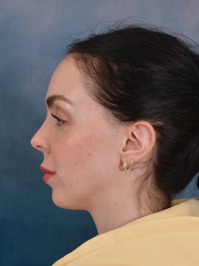 Rhinoplasty Before & After Gallery - Patient 61874293 - Image 1
