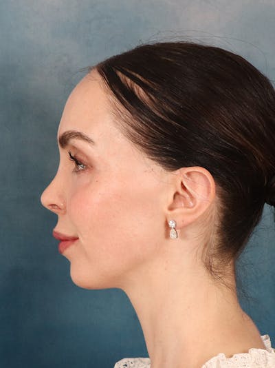 Rhinoplasty Before & After Gallery - Patient 61874293 - Image 2