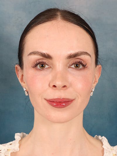 Rhinoplasty Before & After Gallery - Patient 61874293 - Image 6