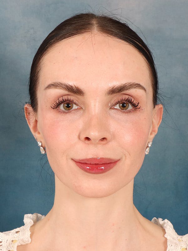 Rhinoplasty Before & After Gallery - Patient 61874293 - Image 6