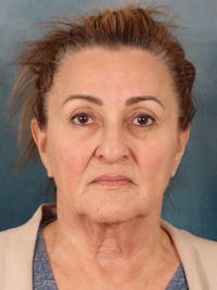 Deep Neck Lift Before & After Gallery - Patient 121660 - Image 1