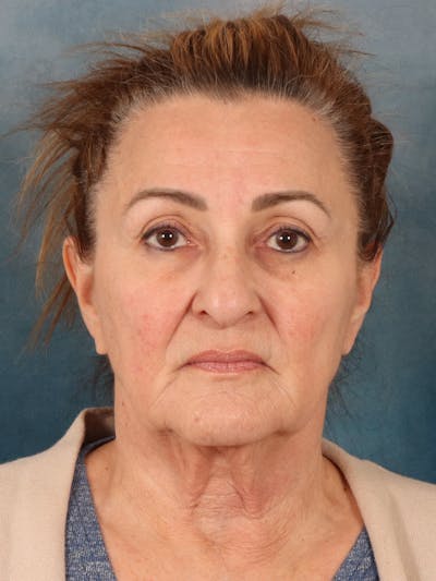 Deep Neck Lift Before & After Gallery - Patient 121660 - Image 1