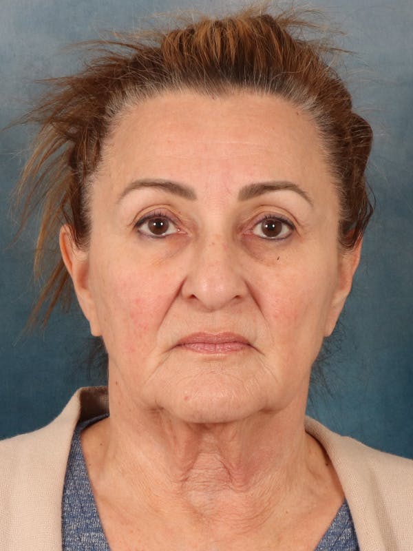 Deep Neck Lift Before & After Gallery - Patient 121660 - Image 1
