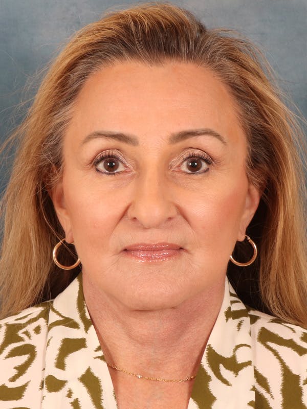Deep Neck Lift Before & After Gallery - Patient 121660 - Image 2