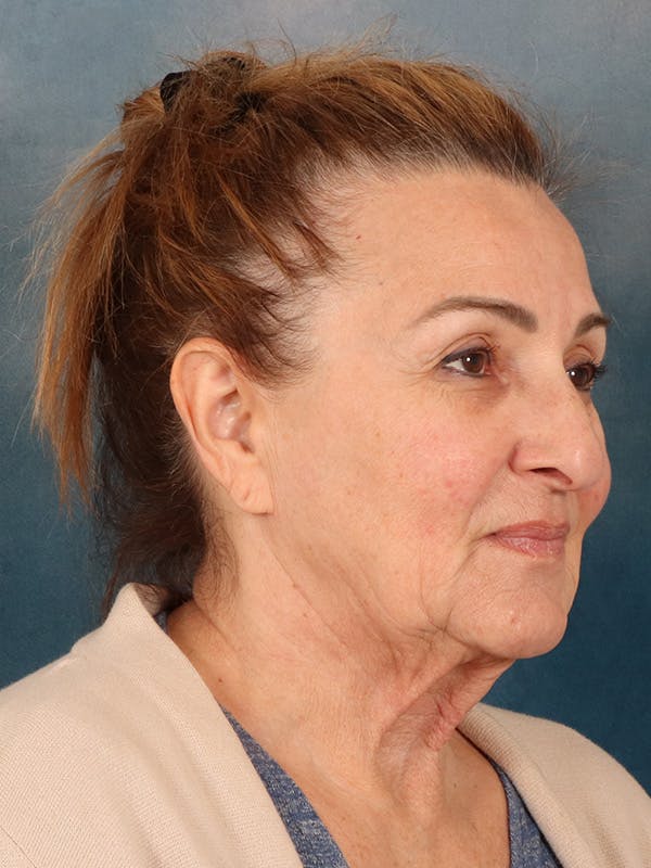 Deep Neck Lift Before & After Gallery - Patient 121660 - Image 7