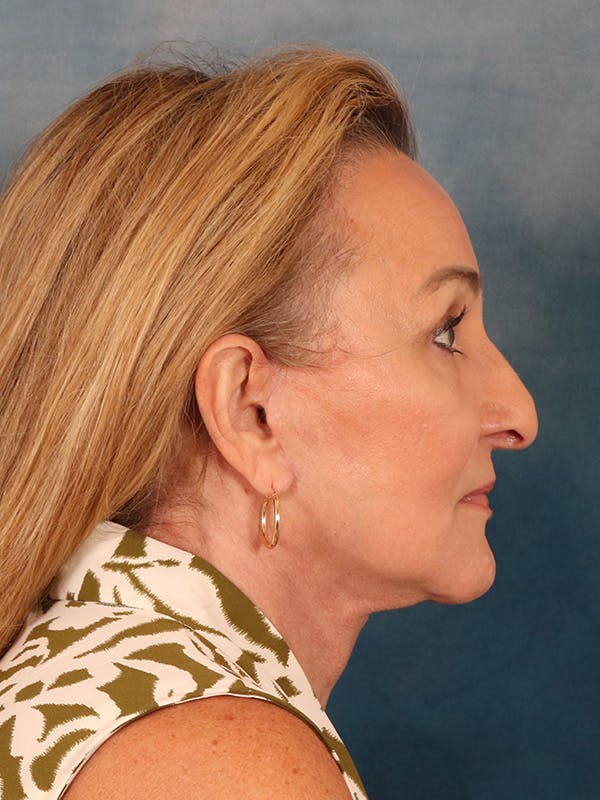 Deep Neck Lift Before & After Gallery - Patient 121660 - Image 10