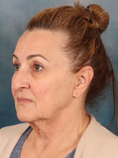 Deep Plane Facelift Before & After Gallery - Patient 331477 - Image 1