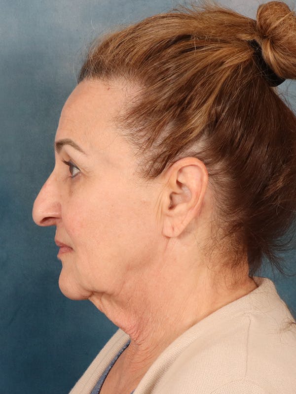 Deep Neck Lift Before & After Gallery - Patient 121660 - Image 5
