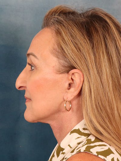 Deep Neck Lift Before & After Gallery - Patient 121660 - Image 6