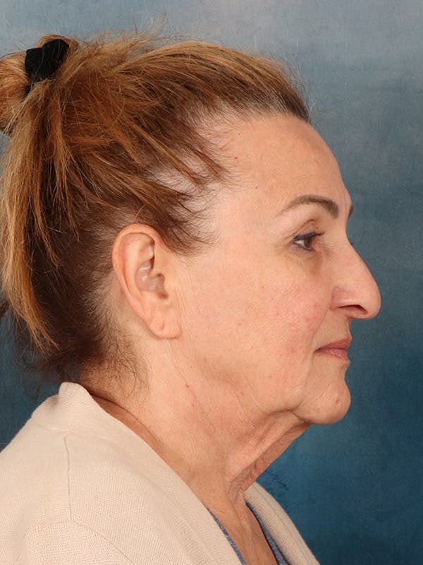 Deep Neck Lift Before & After Gallery - Patient 121660 - Image 9