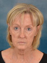 Laser Skin Resurfacing Before & After Gallery - Patient 124178 - Image 1