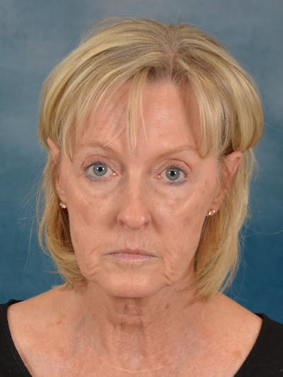 Laser Skin Resurfacing Before & After Gallery - Patient 124178 - Image 1