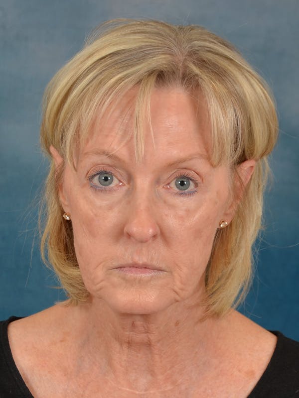Laser Skin Resurfacing Before & After Gallery - Patient 124178 - Image 1
