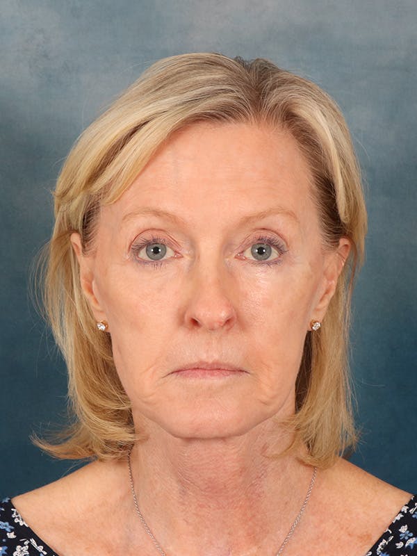 Laser Skin Resurfacing Before & After Gallery - Patient 124178 - Image 2