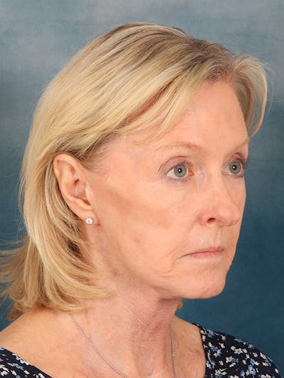 Laser Skin Resurfacing Before & After Gallery - Patient 124178 - Image 8