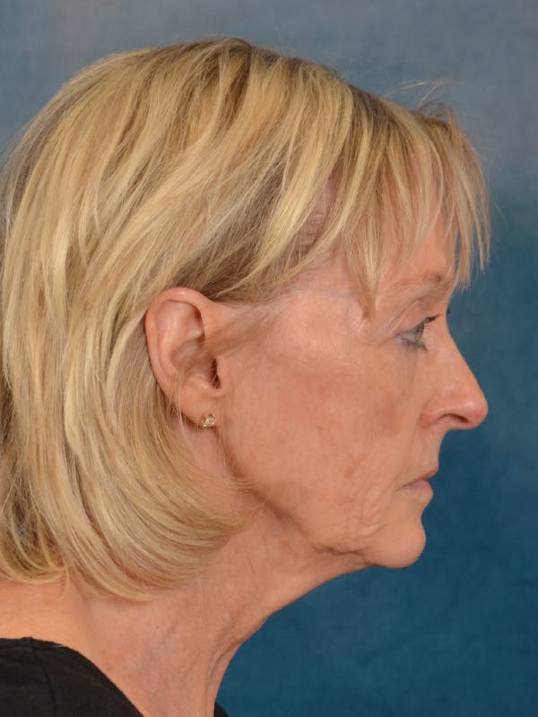 Laser Skin Resurfacing Before & After Gallery - Patient 124178 - Image 9