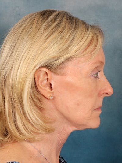 Laser Skin Resurfacing Before & After Gallery - Patient 124178 - Image 10