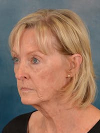 Deep Plane Facelift Before & After Gallery - Patient 179748 - Image 1
