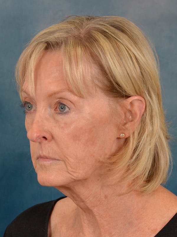 Laser Skin Resurfacing Before & After Gallery - Patient 124178 - Image 3