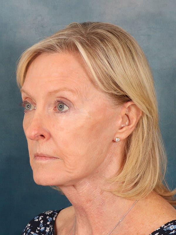 Laser Skin Resurfacing Before & After Gallery - Patient 124178 - Image 4
