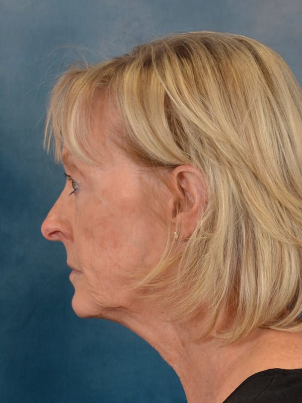 Laser Skin Resurfacing Before & After Gallery - Patient 124178 - Image 5