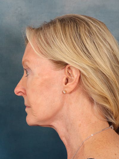 Laser Skin Resurfacing Before & After Gallery - Patient 124178 - Image 6
