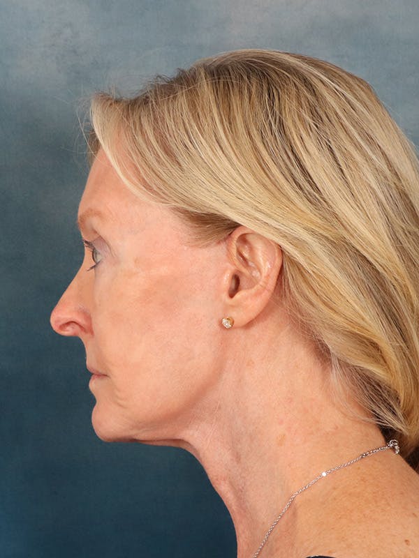 Laser Skin Resurfacing Before & After Gallery - Patient 124178 - Image 6