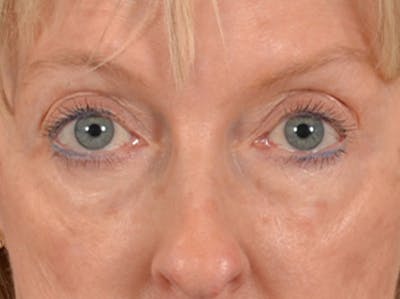 Eyelid Lift Before & After Gallery - Patient 360220 - Image 1