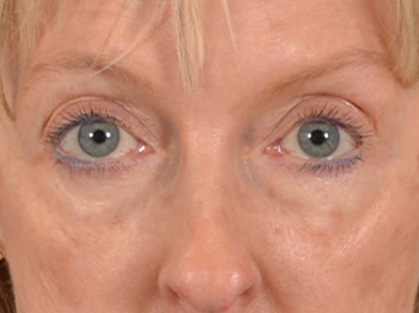 Eyelid Lift Before & After Gallery - Patient 360220 - Image 1
