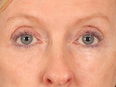 Eyelid Lift Before & After Gallery - Patient 360220 - Image 2