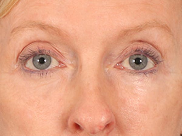 Eyelid Lift Before & After Gallery - Patient 360220 - Image 2