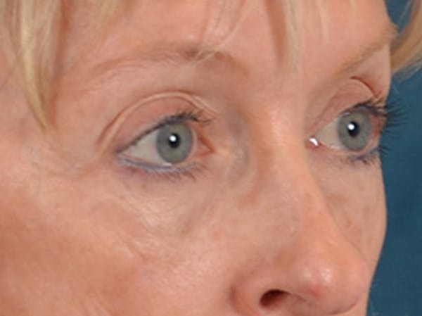 Eyelid Lift Before & After Gallery - Patient 360220 - Image 3