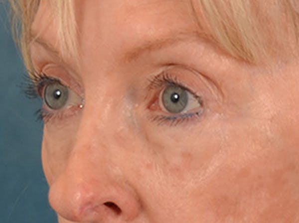 Eyelid Lift Before & After Gallery - Patient 360220 - Image 7