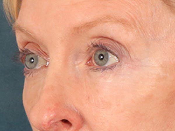 Eyelid Lift Before & After Gallery - Patient 360220 - Image 8