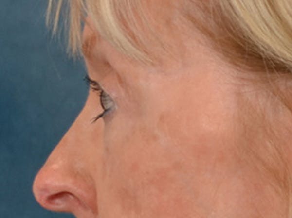 Eyelid Lift Before & After Gallery - Patient 360220 - Image 9