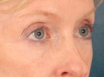 Eyelid Lift Before & After Gallery - Patient 360220 - Image 4