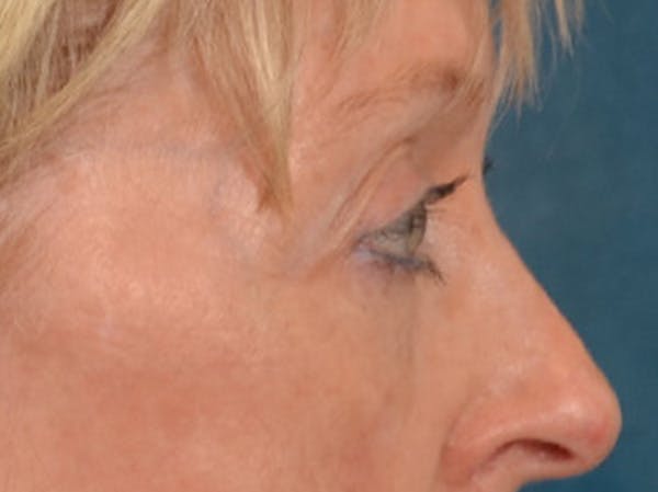 Eyelid Lift Before & After Gallery - Patient 360220 - Image 5