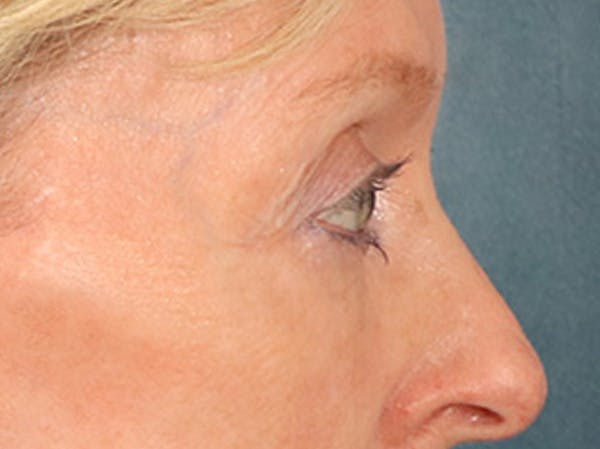Eyelid Lift Before & After Gallery - Patient 360220 - Image 6