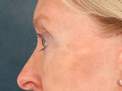 Eyelid Lift Before & After Gallery - Patient 360220 - Image 10