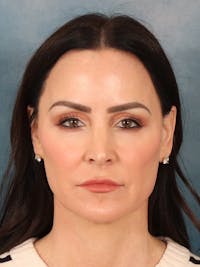 Deep Neck Lift Before & After Gallery - Patient 396626 - Image 1