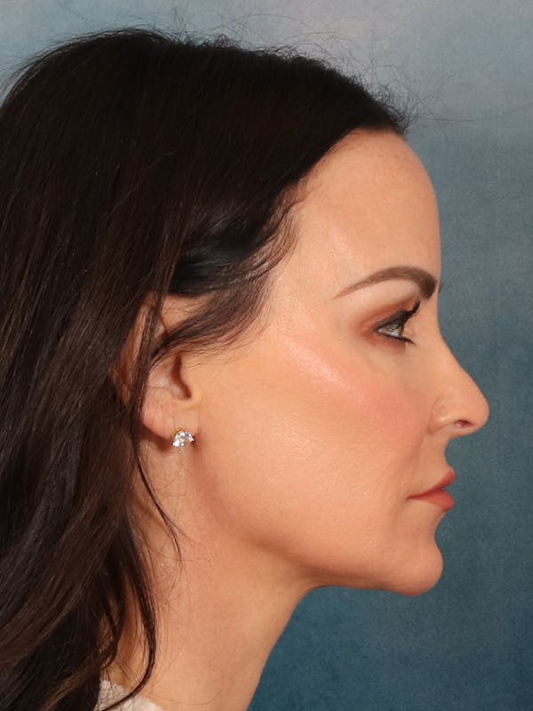 Deep Neck Lift Before & After Gallery - Patient 396626 - Image 7