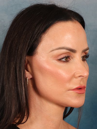 Deep Neck Lift Before & After Gallery - Patient 396626 - Image 10