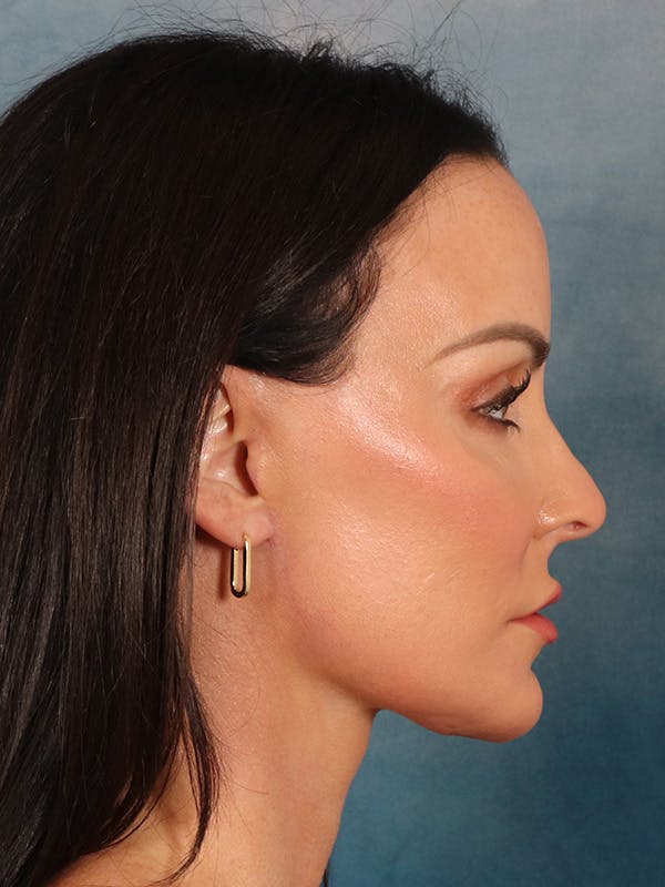 Deep Neck Lift Before & After Gallery - Patient 396626 - Image 8