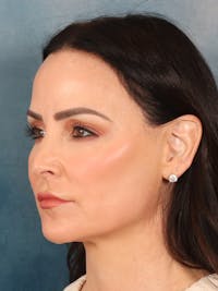 Deep Plane Facelift Before & After Gallery - Patient 148969 - Image 1