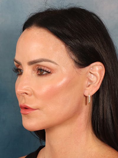Deep Neck Lift Before & After Gallery - Patient 396626 - Image 4