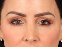 Eyelid Lift Before & After Gallery - Patient 137947 - Image 1