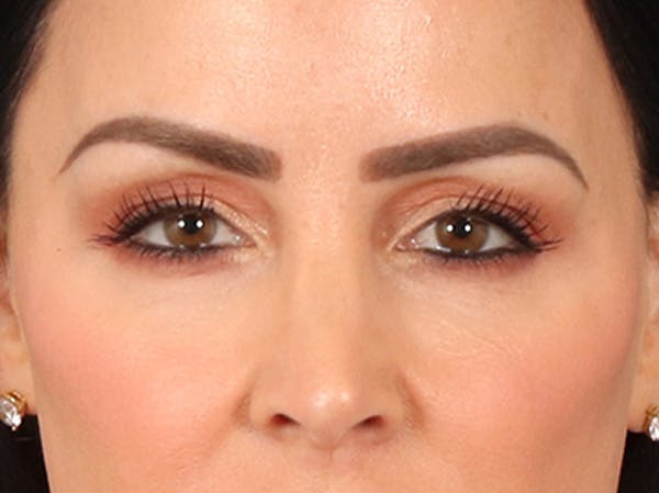 Eyelid Lift Before & After Gallery - Patient 137947 - Image 1