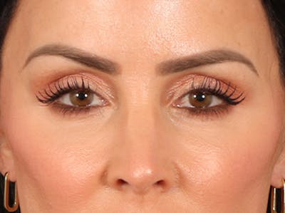 Eyelid Lift Before & After Gallery - Patient 137947 - Image 2