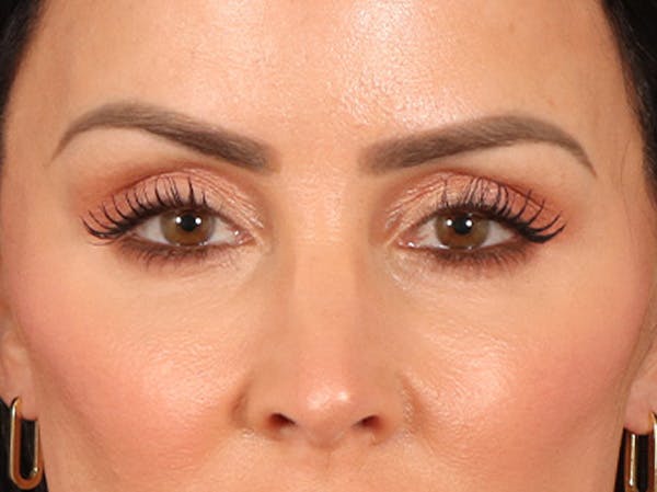 Eyelid Lift Before & After Gallery - Patient 137947 - Image 2
