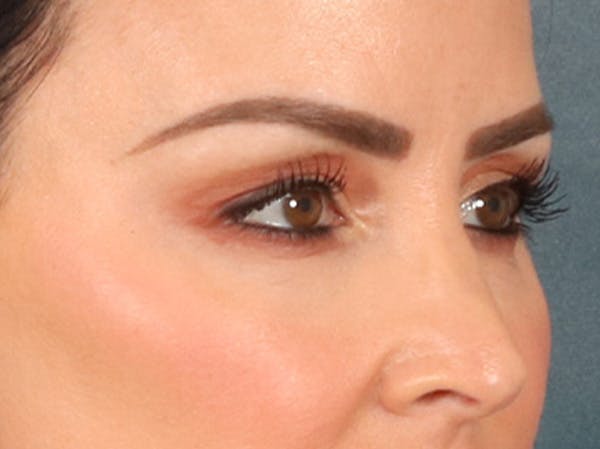 Eyelid Lift Before & After Gallery - Patient 137947 - Image 3